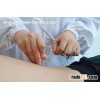 Acupuncture